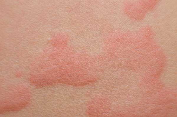 Skin allergy